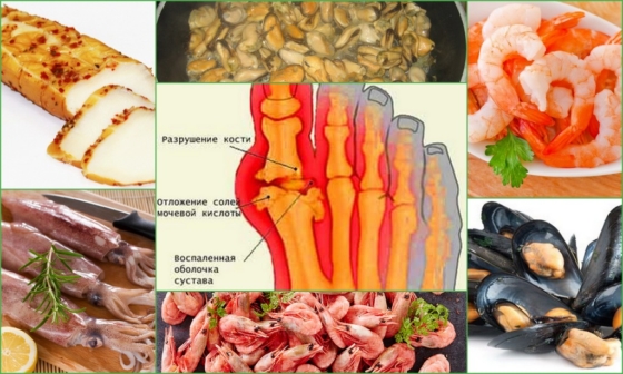 Польза морепродуктов при подагре