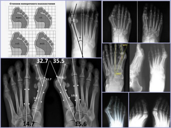 Рентгенологические снимки поперечного плоскостопия 2 степени