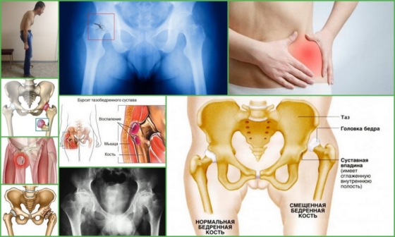 Причины болей в тазобедренном суставе