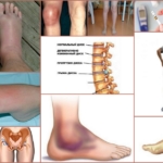 Причины онемения мизинца на ноге