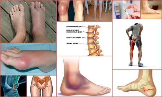 Причины онемения мизинца на ноге