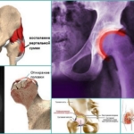 Причины развития болей в тазобедренном суставе