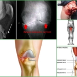 Причины развития контрактуры колена
