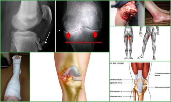 Причины развития контрактуры колена