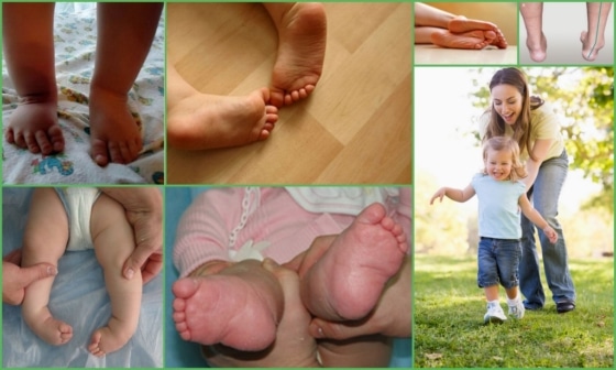 Причины развития косолапости у ребенка