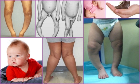 Причины развития ног колесом у ребенка