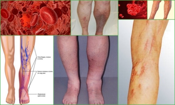 Тромбоз глубоких вен голени
