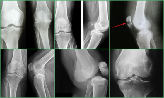 Признаки патологий, которые можно увидеть на рентгене