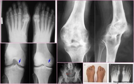 Признаки псориатического артрита на рентгене