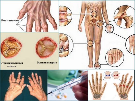 Признаки ревматического артрита