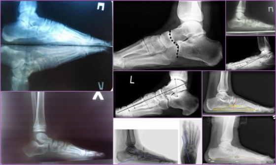 Продольное плоскостопие на рентгеновском снимке
