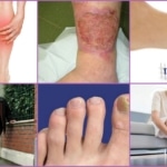Проявления облитерирующего атеросклероза на ногах