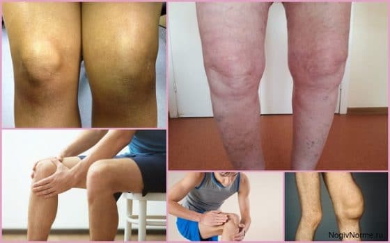 Проявления остеоартроза колена на разных стадиях