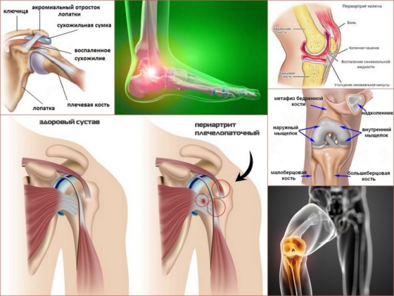 Проявления периартрита у человека