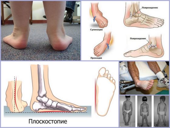 Рахитическое, травматическое и статическое плоскостопие