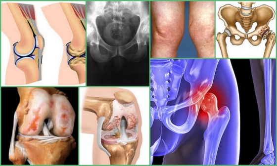 Разновидности артроза суставов у пациента