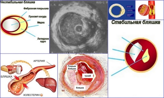 Разновидности атеросклеротических бляшек