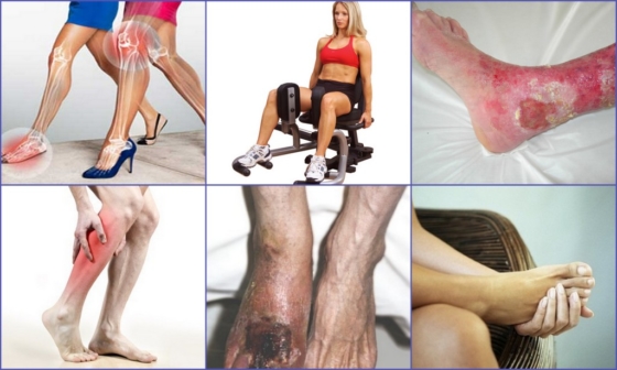 Разновидности атеросклероза сосудов на ногах