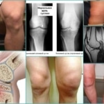 Разновидности болезней колена и их проявления