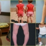 Разновидности деформаций ног у детей