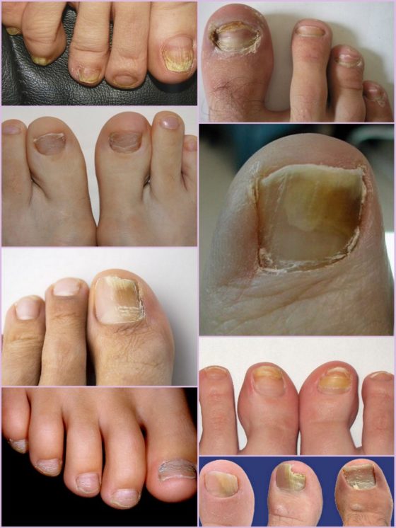 Разновидности грибка ногтей