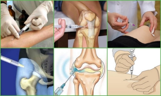 Разновидности инъекций для суставов