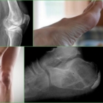 Разновидности кисты на ногах, внешние проявления и рентген