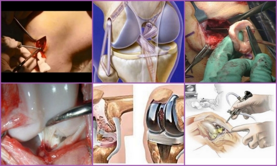 Разновидности операций на коленном суставе