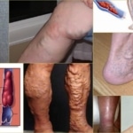 Разновидности тромбофлебита на ногах