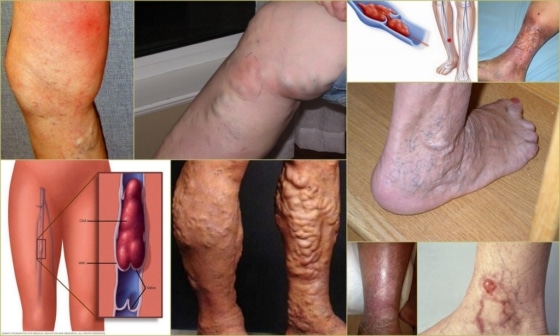 Разновидности тромбофлебита на ногах