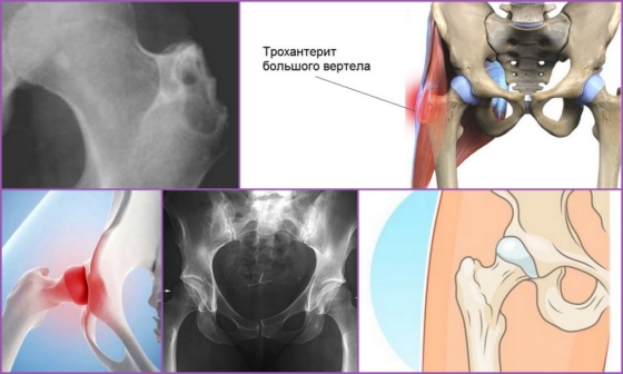 Разновидности заболевания трохантеритом