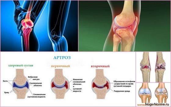 Разные формы артроза коленного сустава