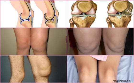 Разные стадии артрита коленного сустава 