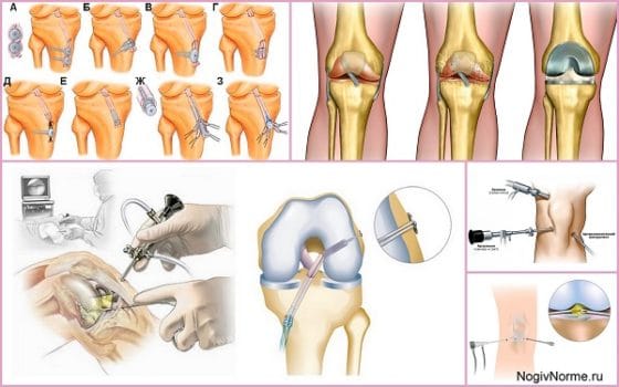 Разные виды артроскопического вмешательства