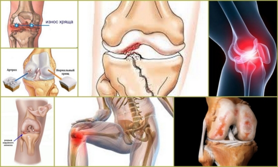 Развитие артроза конечностей