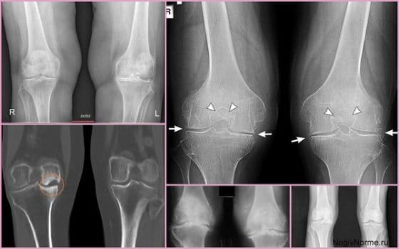 Развитие гонартроза 3 степени колена