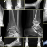 Рентген голеностопного сустава - снимки