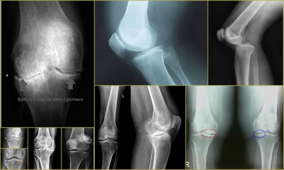 Рентген коленного сустава для определения патологии