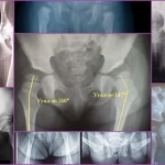 Рентген при дисплазии тазобедренного сустава у малышей