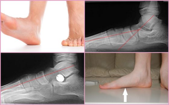 Рентген стоп при плоскостопии