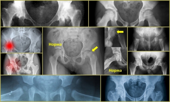 Рентген тазобедренного сустава – снимки обследования