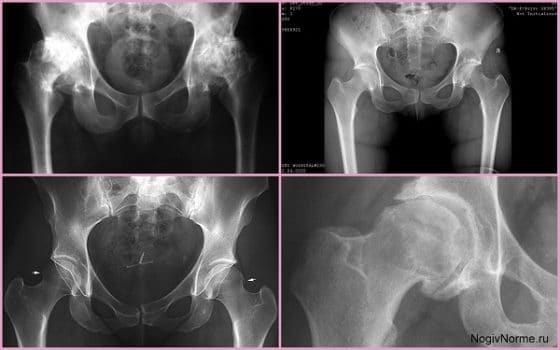 Рентгенологические признаки коксартроза ТБС