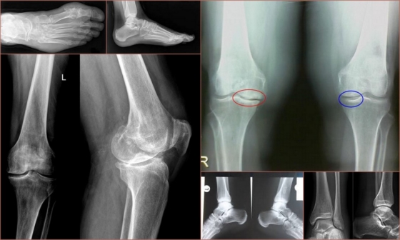 Рентгеновские снимки артроза голени