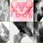 Рентгеновские снимки при дисплазии тазобедренного сустава