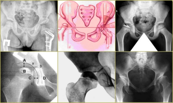 Рентгеновские снимки при дисплазии тазобедренного сустава