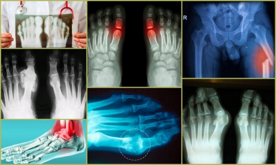 Рентгеновские снимки заболевания
