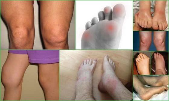 Ревматизм на ногах – внешние проявления патологии