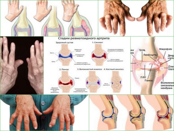 Ревматоидный артрит, внешний вид