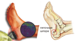 Воздействие ультразвуком на пяточную шпору