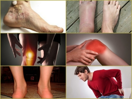 Симптоматика артроза ног